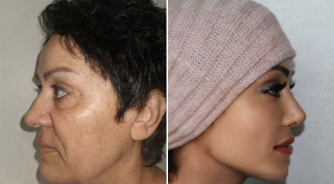 Procedimiento estético se vuelve viral por sorprendente 